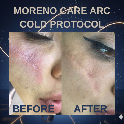 ARC Cold Protokol Leke Ve Kırışıklık Giderme