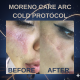 ARC Cold Protokol Leke Ve Kırışıklık Giderme