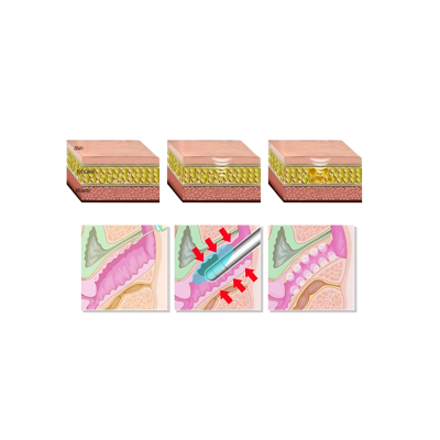 Ayaklı Çift Başlıklı Vajinal HIFU (Yüz-Vücut-Vajina)