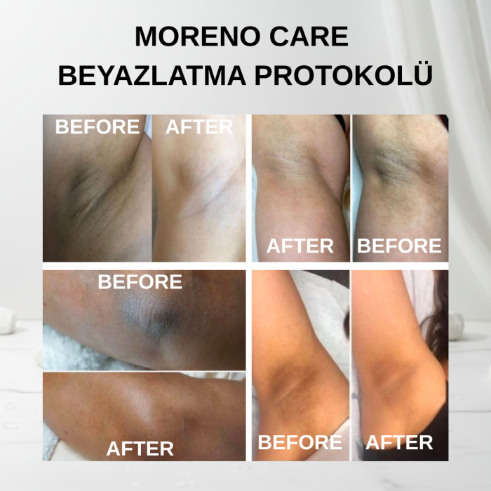 Beyazlatma Protokolü