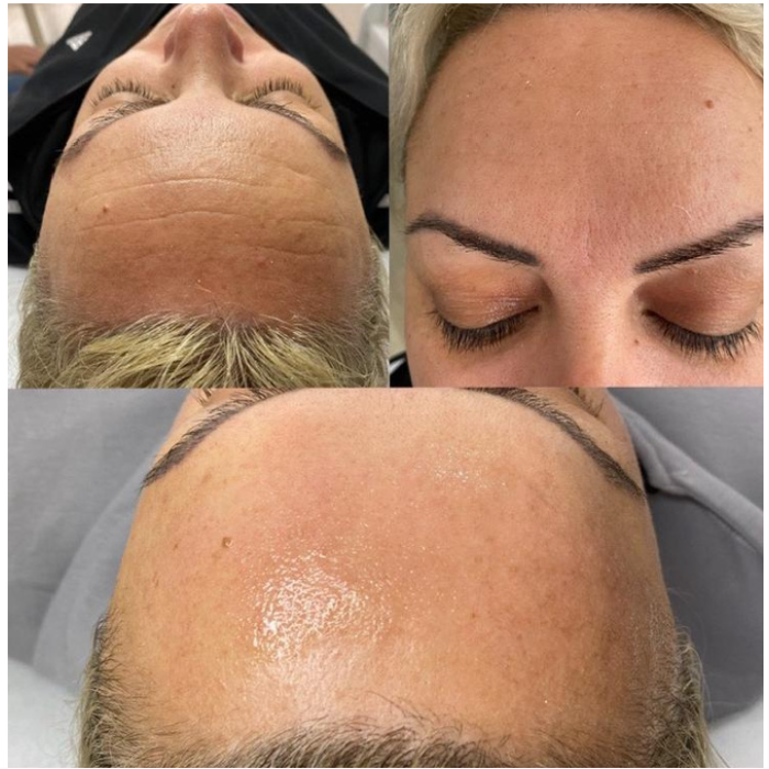 Collagen İp Protokolü Kırışıklık Giderme