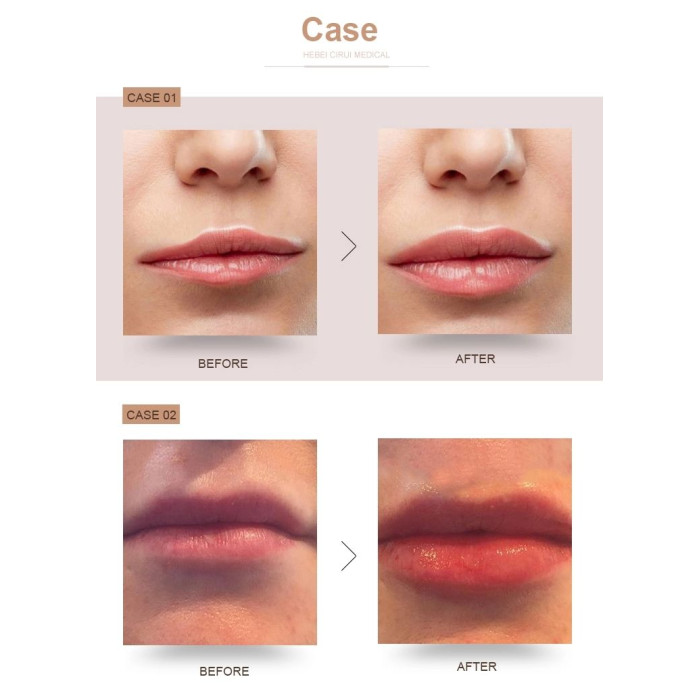 Hyaluron Pen Dudak Dolgu Kalemi