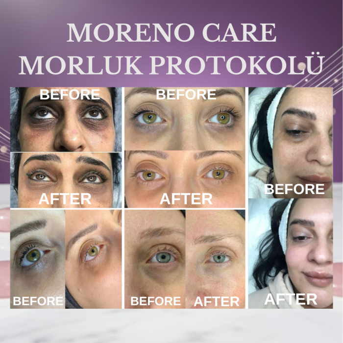 Morluk Protokolü