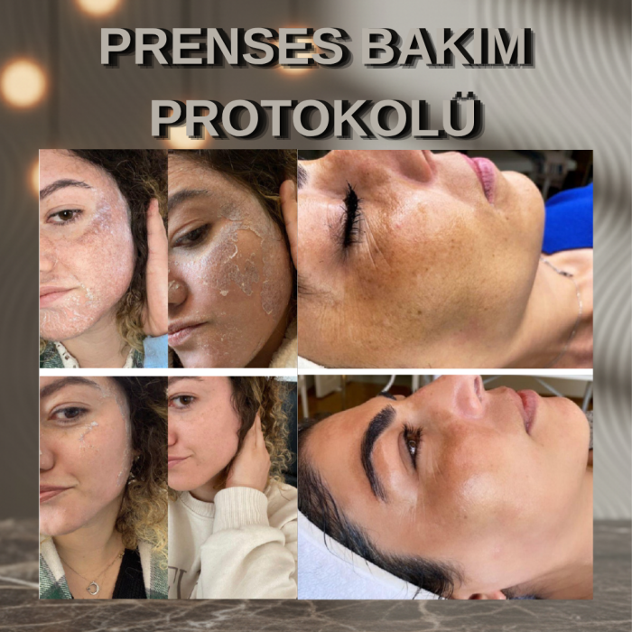 Prenses Bakım Protokolü