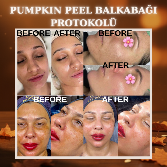 Pumpkin Peel Bal Kabağı Protokolü