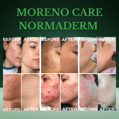 Akne Protokolü Yosun Peeling